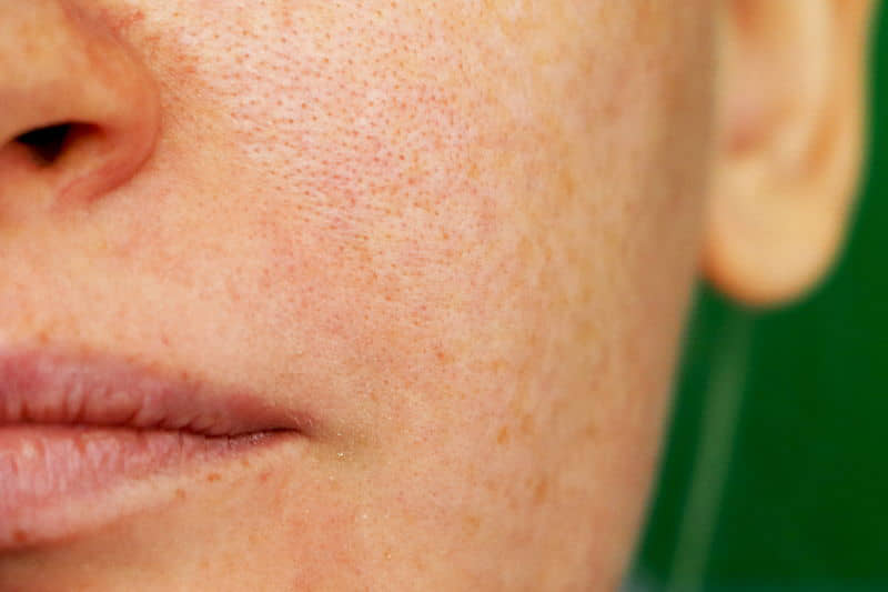Išsiplėtusios odos poros: ką daryti