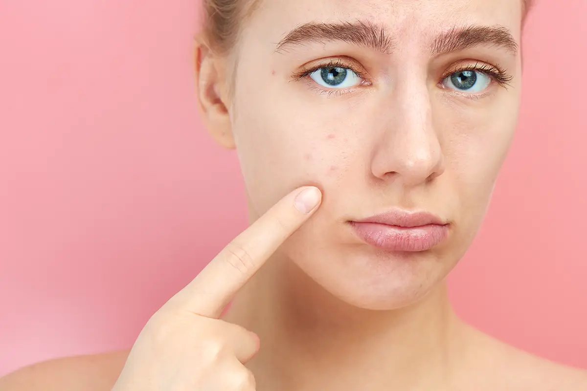 Kaip prižiūrėti spuoguotą odą?