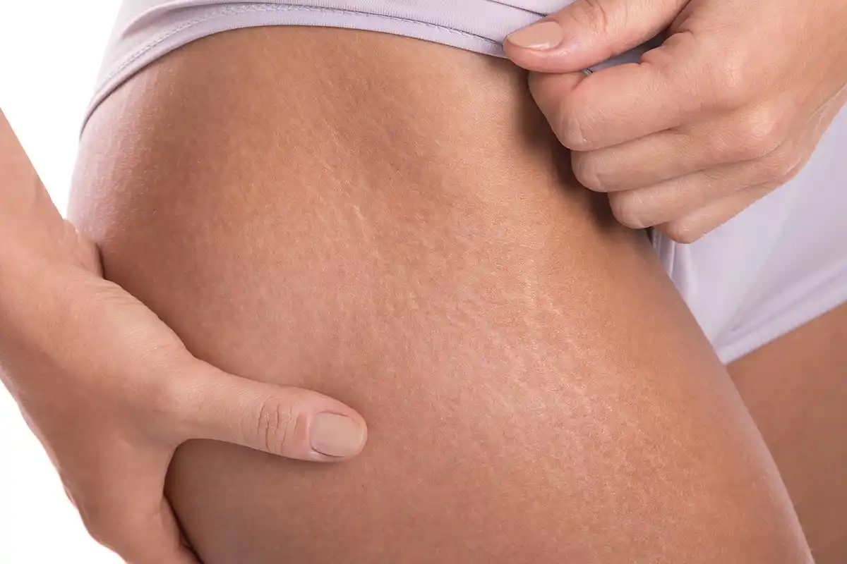 Strijos: gydymas ir prevencija