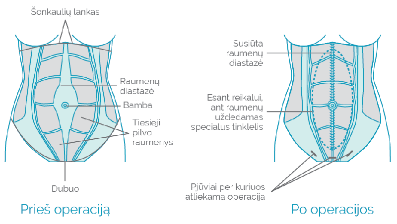 pilvo sienos operacijos rezultatai