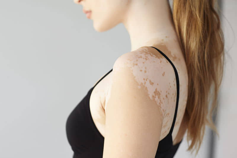 Baltmė (vitiligo): priežastys, simptomai ir gydymas