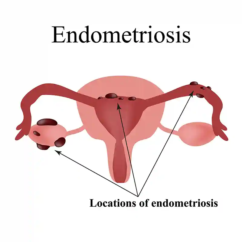 Endometriozė