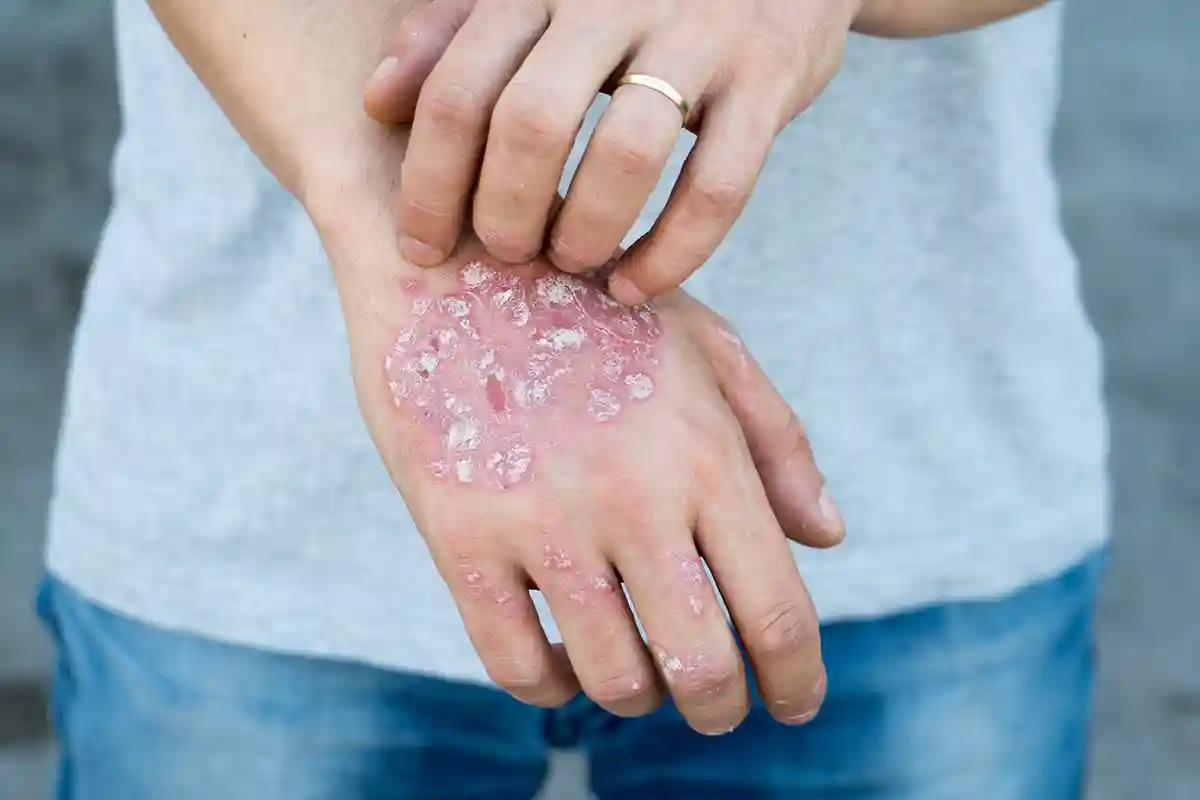 Žvynelinė (psoriazė)