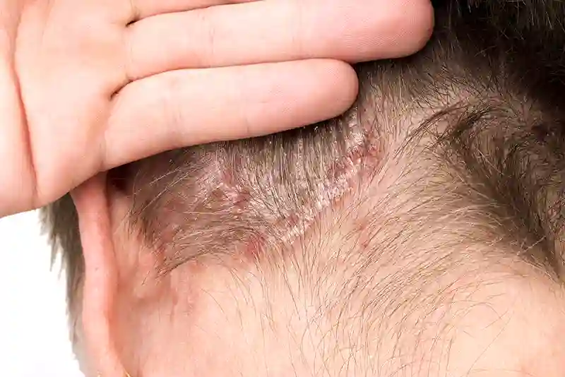 zvyneline psoriaze gydymas