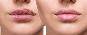 Lūpų pūslelinė (Herpes virusas)