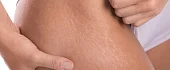 Strijos: gydymas ir prevencija